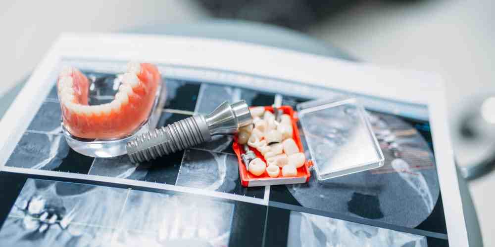 Case Study: Restoring Oral Health with a Single Dental Implant